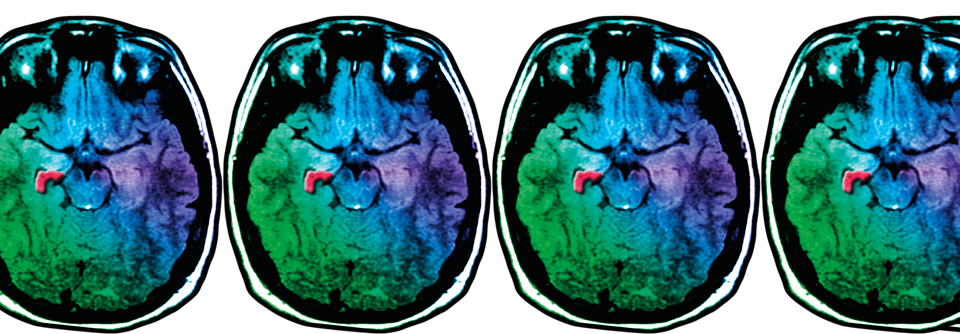 Jeder Patient mit einem ersten Krampf­anfall sollte eine MRT erhalten, um strukturelle Läsionen wie eine Hippo­campussklerose (rot) zu erkennen.
