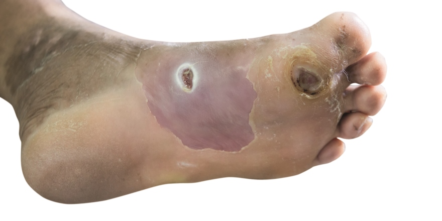 Wundfarbe anschauen und passende Auflage wählen!