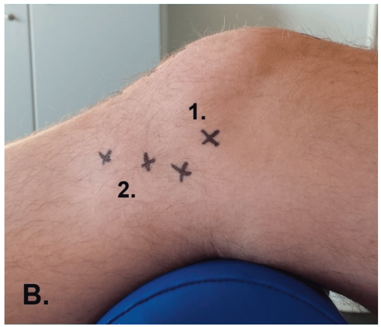 Ansicht medial: 1. medialer Gelenkspalt
2. Verlauf Pes anserinus