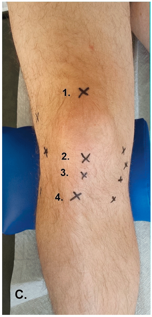 Ansicht frontal: 1. proximaler Patellapol/Quadricepssehne, 2. distaler Patellapol, 3. Patellasehne, 
4. Tuberositas tibiae