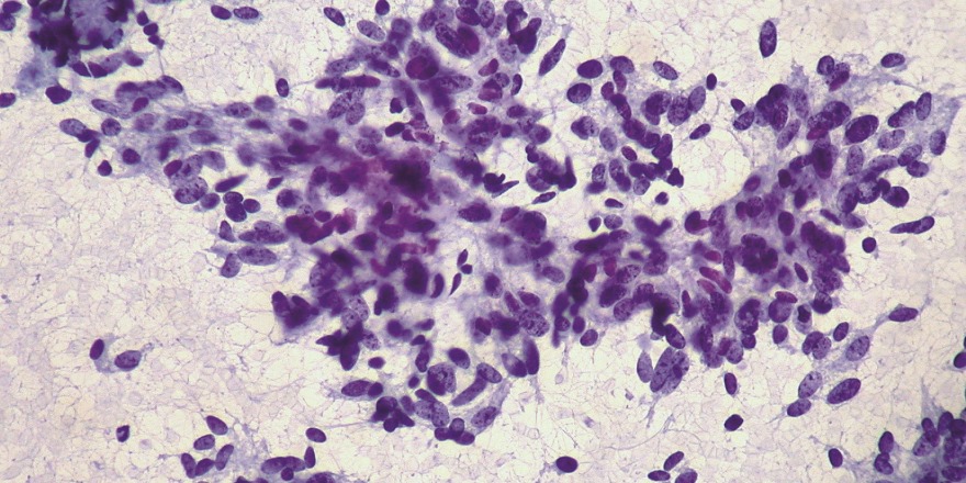 Hier schwirren die Zellen eines Karzinoid-Tumors in der Lunge herum.