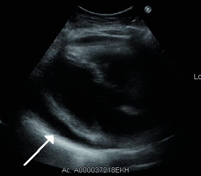 Echokardiographisch lässt sich die Flüssigkeitsansammlung im Herzbeutel sehr deutlich darstellen.
© wikimedia/James Heilmann.