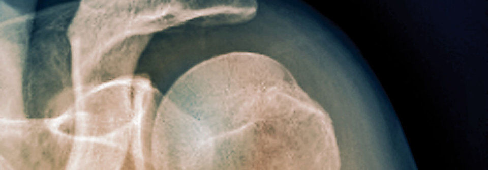 Manch ältere Dame kugelt sich die Schulter aus, wenn sie auf den gestreckten Arm fällt.