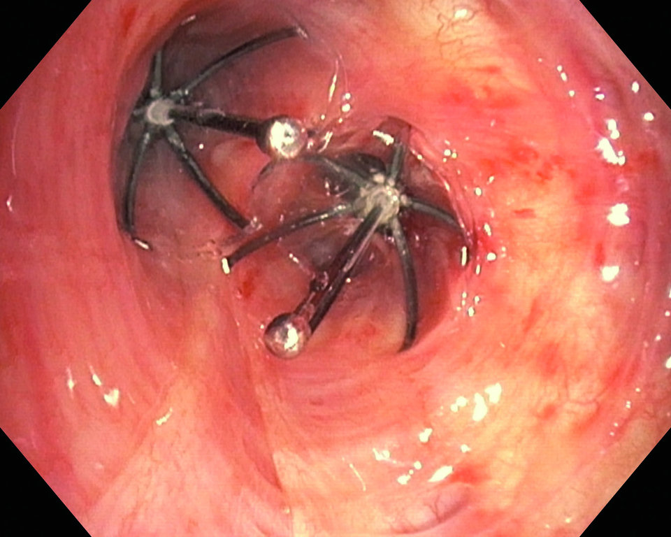 Hier hat man mit einem intrabronchialen Ventil den linken Oberlappen verschlossen.

