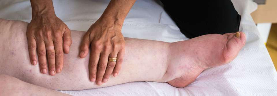 Die Inzidenz des sekundären Lymphödems liegt bei 0,13–2 %.
