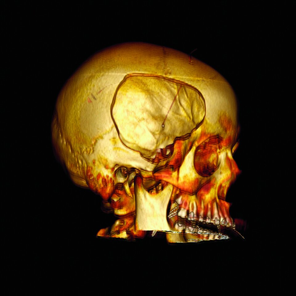 Ob eine Kraniektomie  oder Kraniotomie er­folgt, entscheiden Operateure derzeit oft nach sub-jektiven Kriterien.
