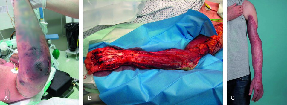 Livide Verfärbungen der Haut deuten auf Nekrosen hin (A). Ein radikales Débridement (B) ist in den meisten Fällen unumgänglich, um die Extremität und das Leben des Patienten zu retten. Die sich anschließende Hautdeckung (C) gehört in die Hände erfahrener plastischer Chirurgen. Eine intensivmedizinische Versorgung sollte gewährleistet sein.