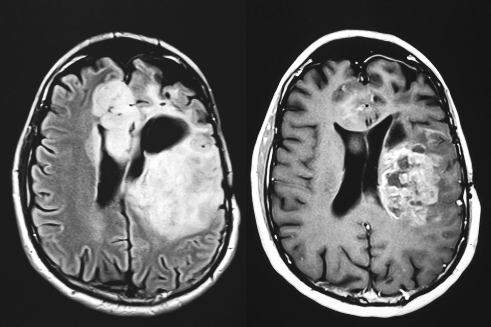 Therapie-Fortschritte bei sekundären ZNS-Lymphomen.
© thinkstock