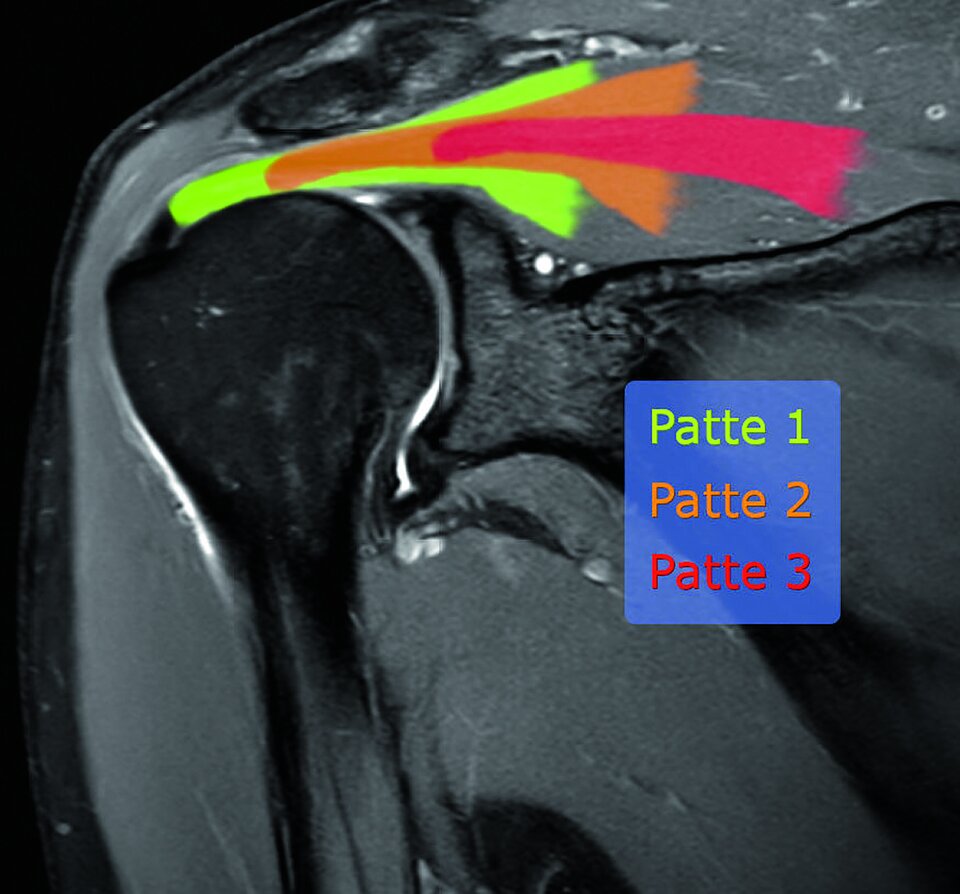 Der Grad der Sehnenretraktion bei der Manschettenruptur wird nach Patte klassifiziert.
