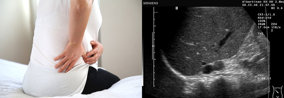 Zufallsbefund Nebennierenvergrößerung. Ob der  Tumor Hormone im Übermaß produziert, lässt sich allein anhand einer Ultraschalluntersuchung nicht sagen.