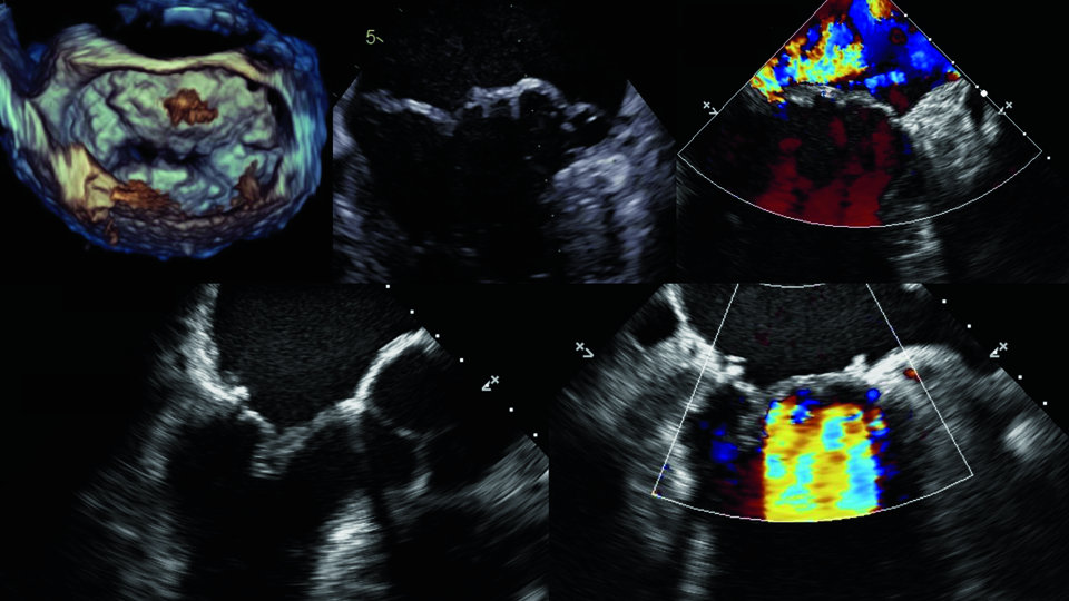 Die OP erfolgte wegen einer hochgradigen Mitralklappeninsuffizienz im Sinne eines M. Barlow. Zu erkennen ist der Reflux in den linken Vorhof.
