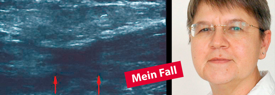 Kasuistik von Dr. Edith Leisten, Fachärztin für Chirurgie MVZ St. Marien GmbH Köln.
