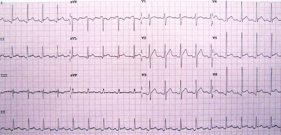 In diesem Perikarditis-EKG sieht man ST-Hebungen über der Vorderwand. 
© wikimedia/James Heilmann.