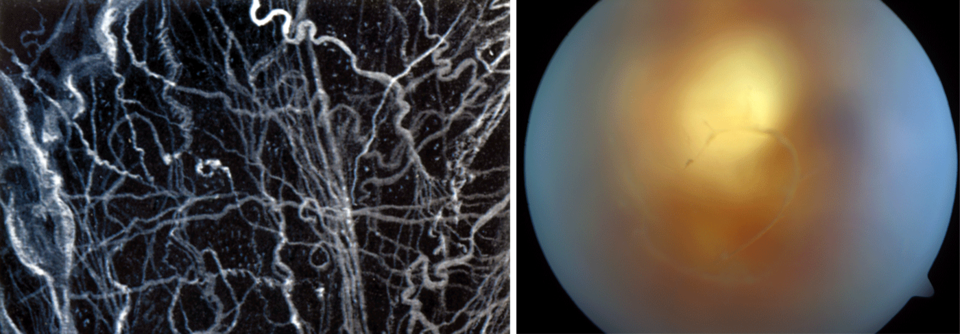 Trotz Laser- und OP-Option lieber abwarten, bis die „Tierchen“ von allein verschwinden.