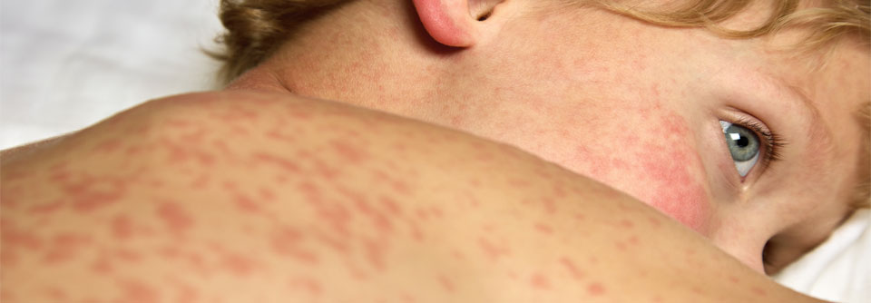 Sad little boy is sick with rubella, lies on a hospital bed covered with spots. Sad child covered with allergic red spots lies sick