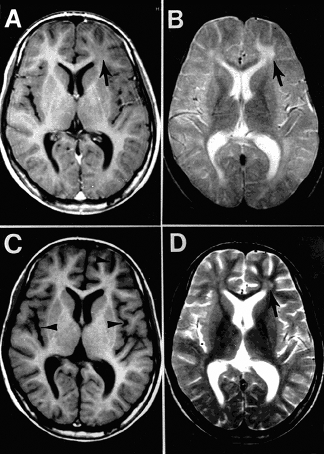 Subakute sklerosierende Panenzephalitis bei Einweisung (A, B) und drei Monate später (C, D). Es besteht eine Anomalie im linken Frontallappen (Pfeil in A, B, D) sowie eine diffuse Atrophie im Kortex (Pfeile in C).