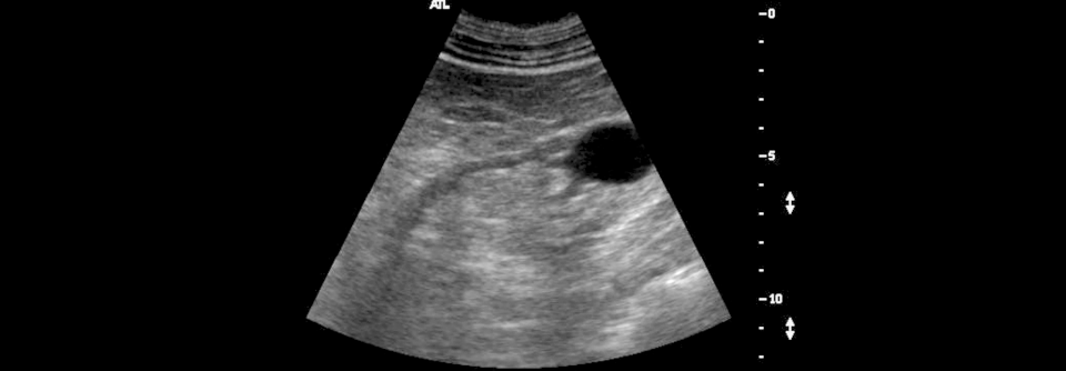 Bei CKD zeigt sich im Ultraschall oft eine diffuse Atrophie der Nierenrinde mit echogenem Parenchym.