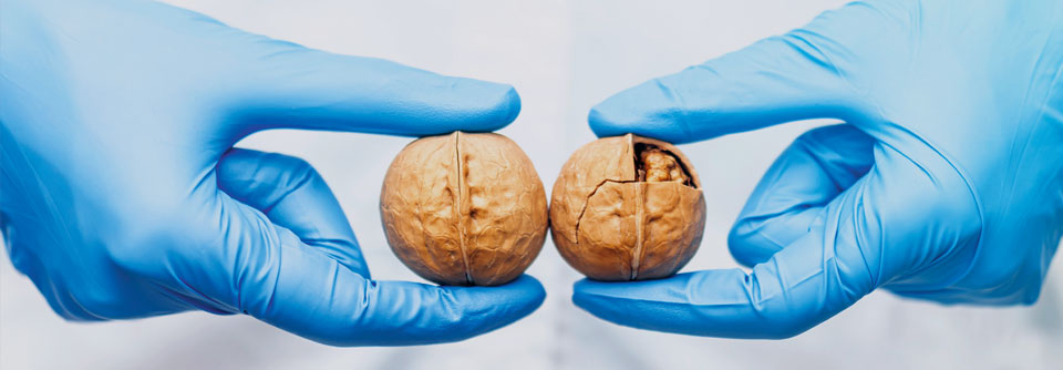 Symbolbild für Hodenkrebs: Zwei Hände mit blauen Handschuhen halten Walnüsse – eine intakt, eine geöffnet.